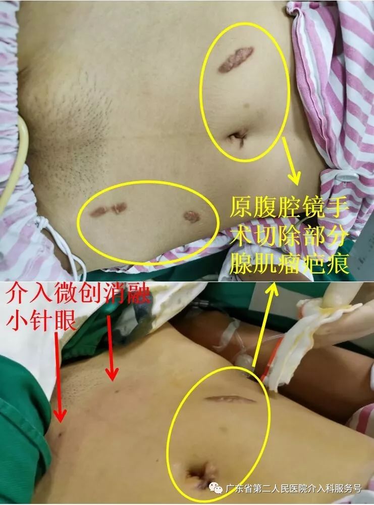 子宫腺肌症痛经伴有大小便也痛,子宫腺肌症痛经切除子宫能根治吗