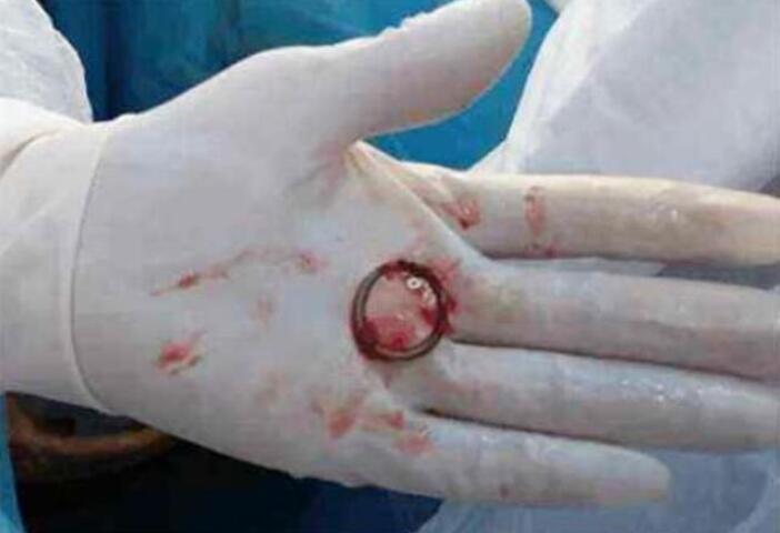 节育环长到肉里怎么取不出来摘,节育环戴11年了能引起出血吗