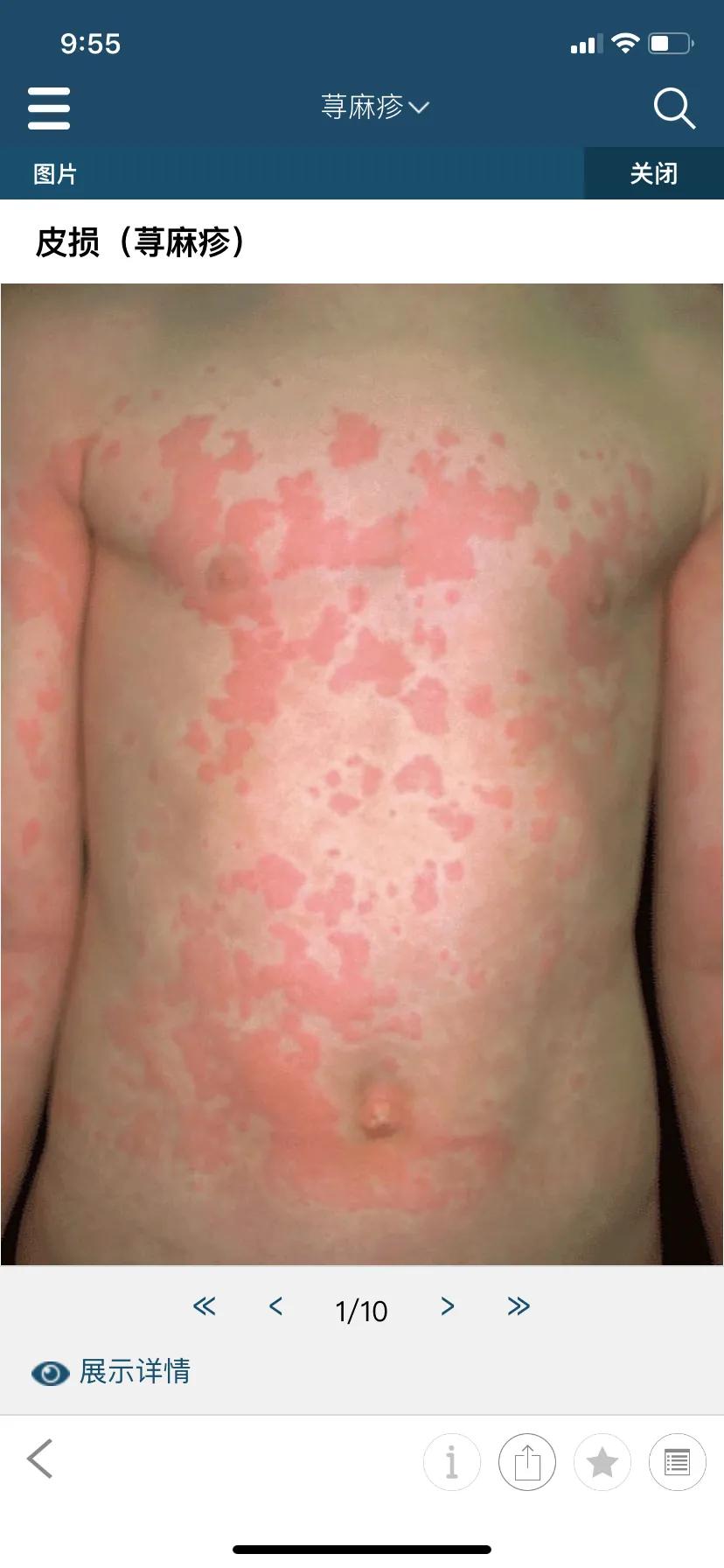 儿童荨麻疹反复发作三招教你搞定,小孩麻疹不治疗自己会好吗