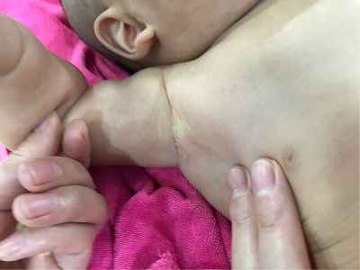 痱子止痒,有效的祛痱子方法