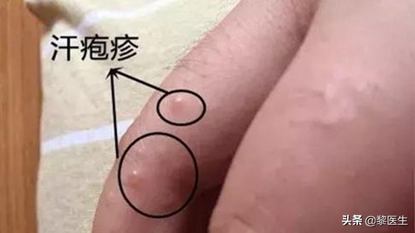 以前没有汗疱疹怎么突然就得了,汗疱疹会截肢吗