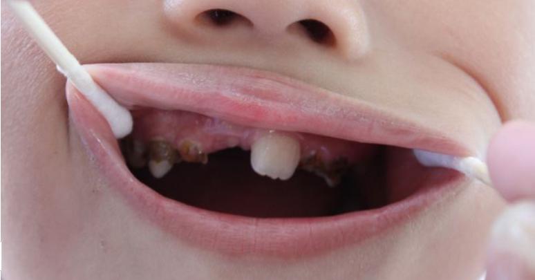 3岁儿童龋齿怎么办,3周小孩龋齿吃什么预防