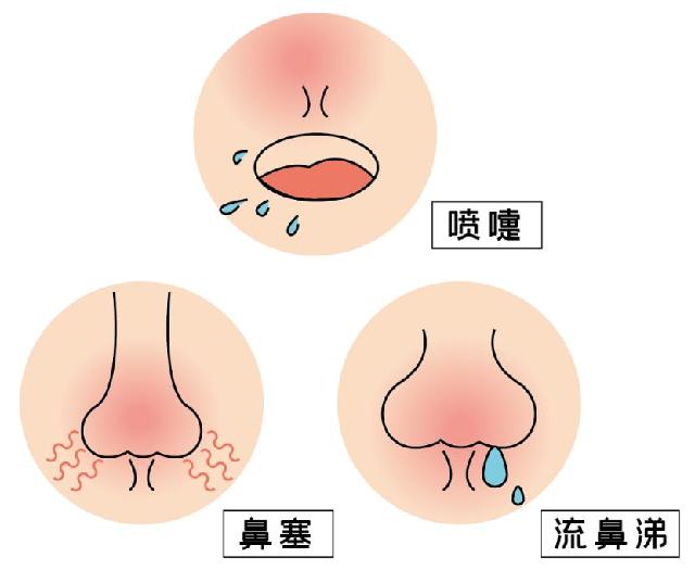 鼻炎七大类，北京京都儿童医院告诉您属于哪一类
