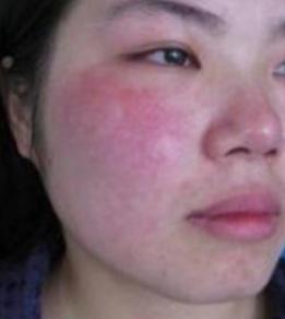 玉泽能修复角质层吗,角质层修复最快方法