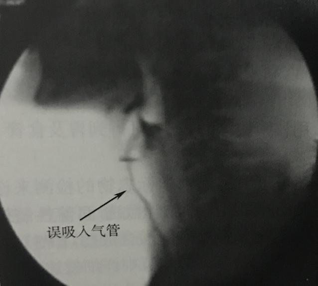 反复肺炎好了以后怎么护理,肺炎吃哪些食物对肺好