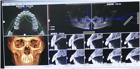 磕断了一排牙,磕断了一半门牙