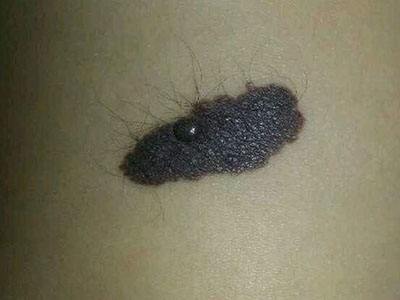 去除黑毛痣手术能医保报销吗,黑毛痣胎记激光能彻底去除吗