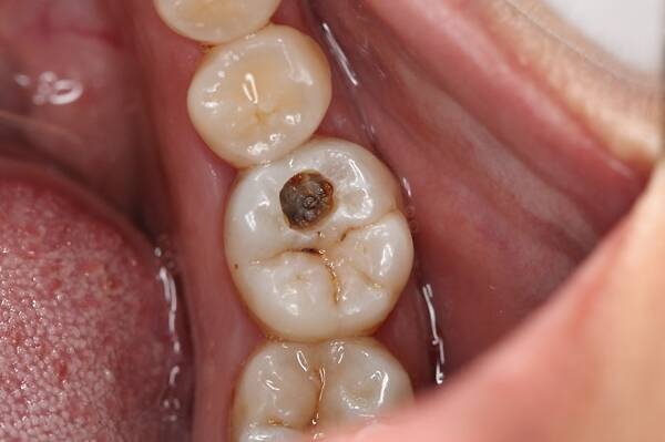 牙生虫牙疼除根偏方,牙疼去牙虫最有效的方法