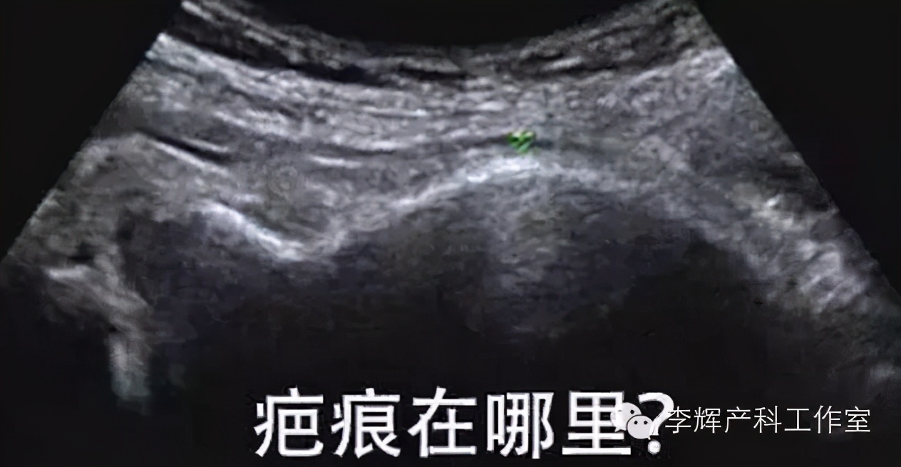 剖宫产术后多久可以出手术室,剖宫产手术后多久可以再进行手术