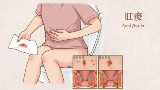 屁股火疖子会引起肛瘘吗,屁股起火疖子出脓要不要挤干净