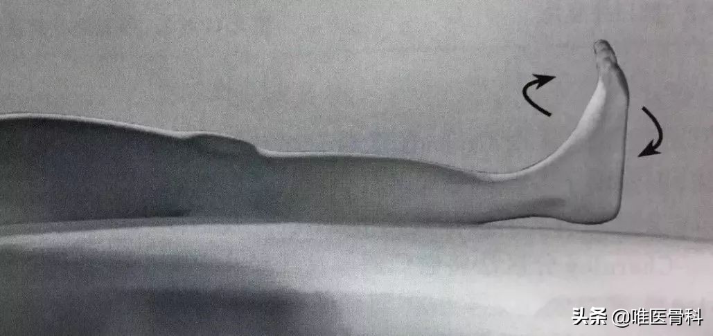 膝关节置换后血栓多长时间能消除,膝关节置换后血栓发病