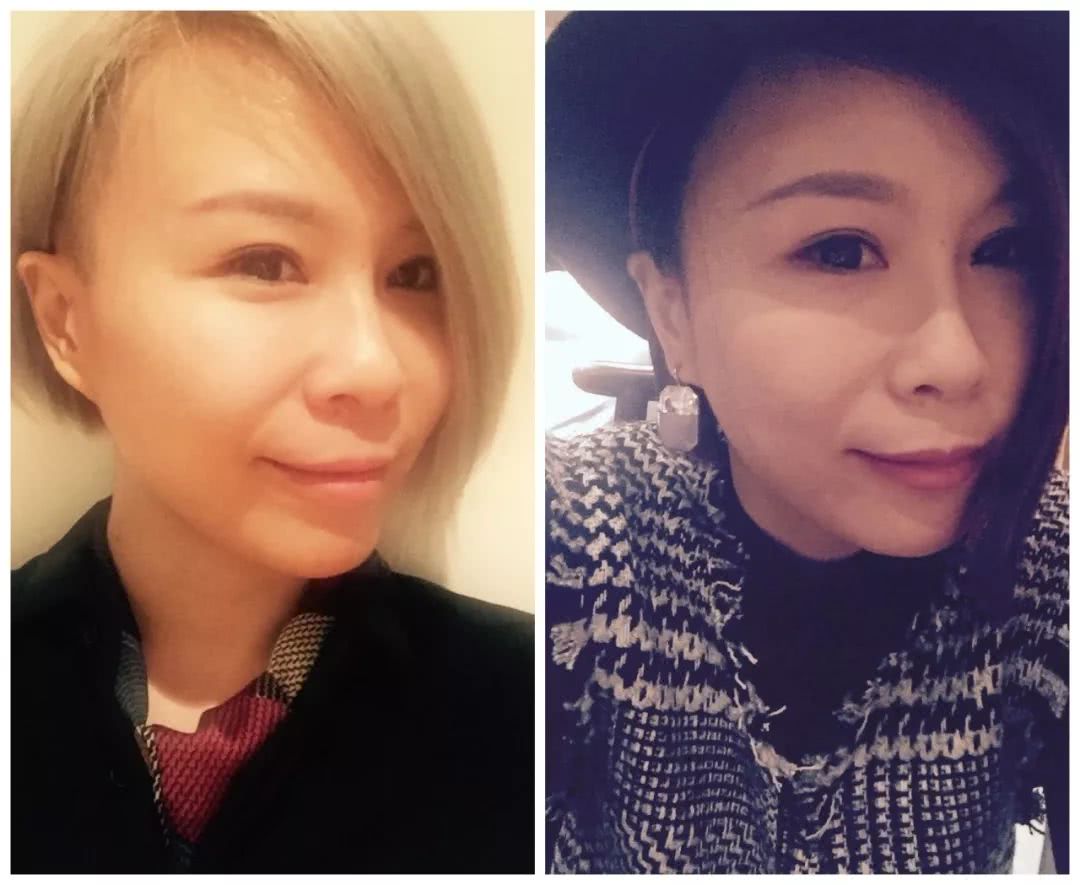 做了微整之后的感悟,微整经验