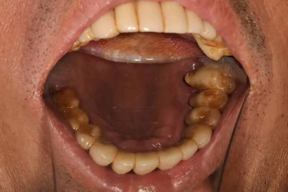 烤瓷牙延长寿命的方法,烤瓷牙的修复方法