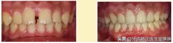 诺尔口腔牙齿矫正怎么样,淄博诺尔漫齿科种植牙价格