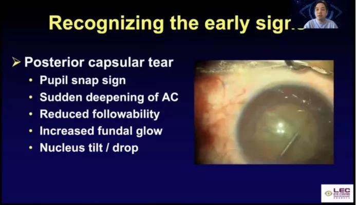 晶状体脱落取硅油还要打油吗,晶状体掉入玻璃体怎么处理