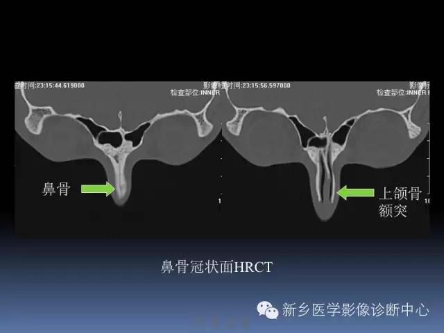 鼻骨骨折在ct片上的表现,鼻骨骨折ct怎么看