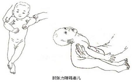 宝宝轻度脑瘫症状是怎么样的,宝宝轻微脑瘫的症状有哪些