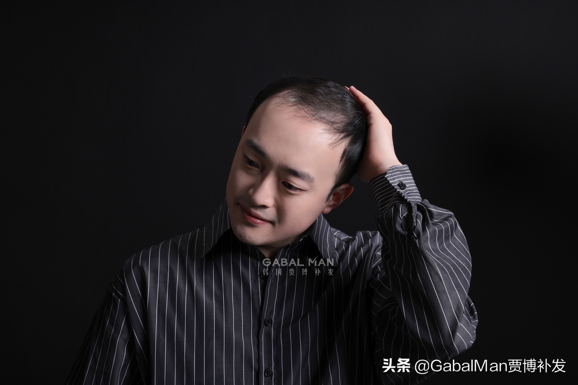 一招教你解决发际线高,发际线过高怎么拯救