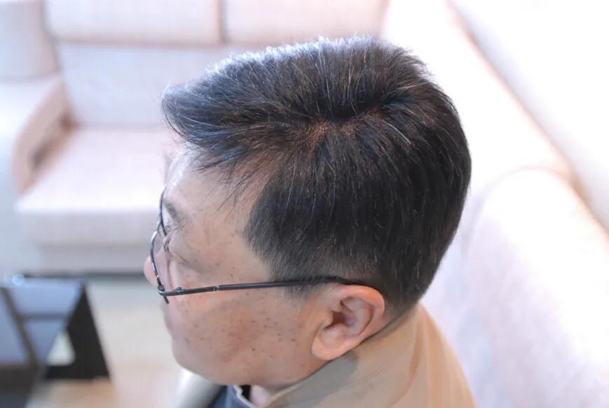 脱发到底该怎么应对,女脱发严重怎么解决