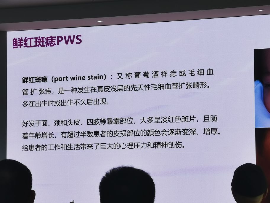 脉冲染料激光治玫瑰痤疮怎么收费,脉冲染料激光治疗瘢痕疙瘩