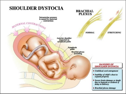新生儿锁骨骨折的常见原因,新生儿锁骨骨折治疗方案