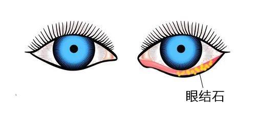 眼结石跟熬夜有关系吗,熬夜对结石有影响吗