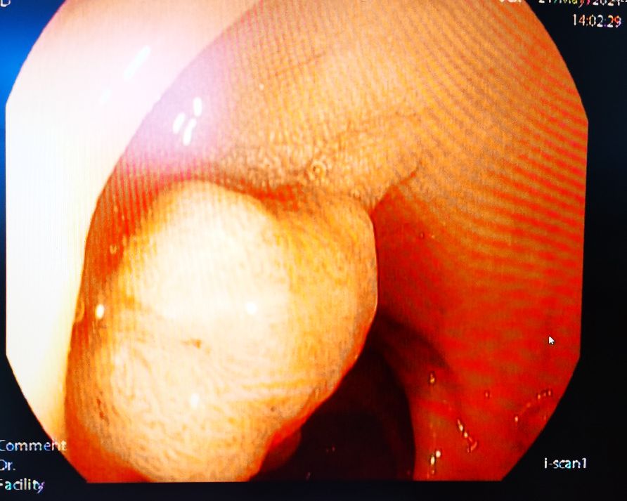肠息肉切除手术危险,恶性肠息肉做微创一般住院几天
