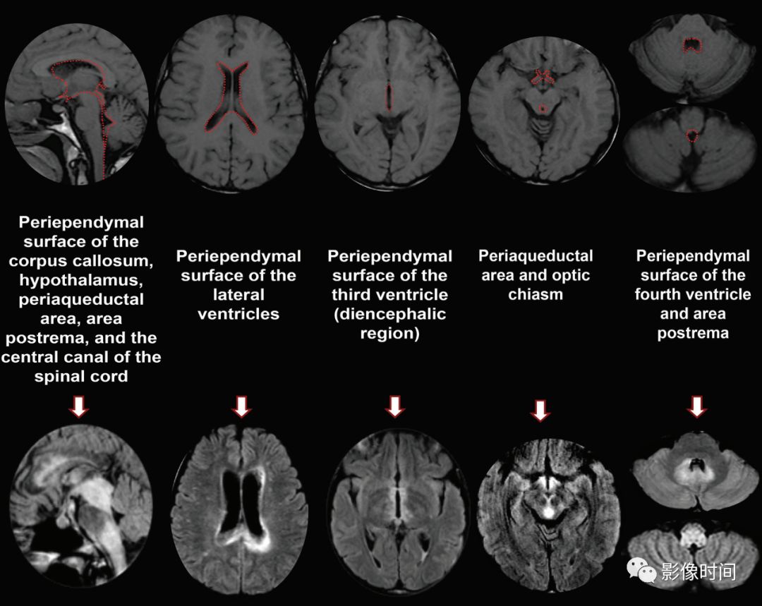 脊髓病变案例图文问诊,脊髓病变视频