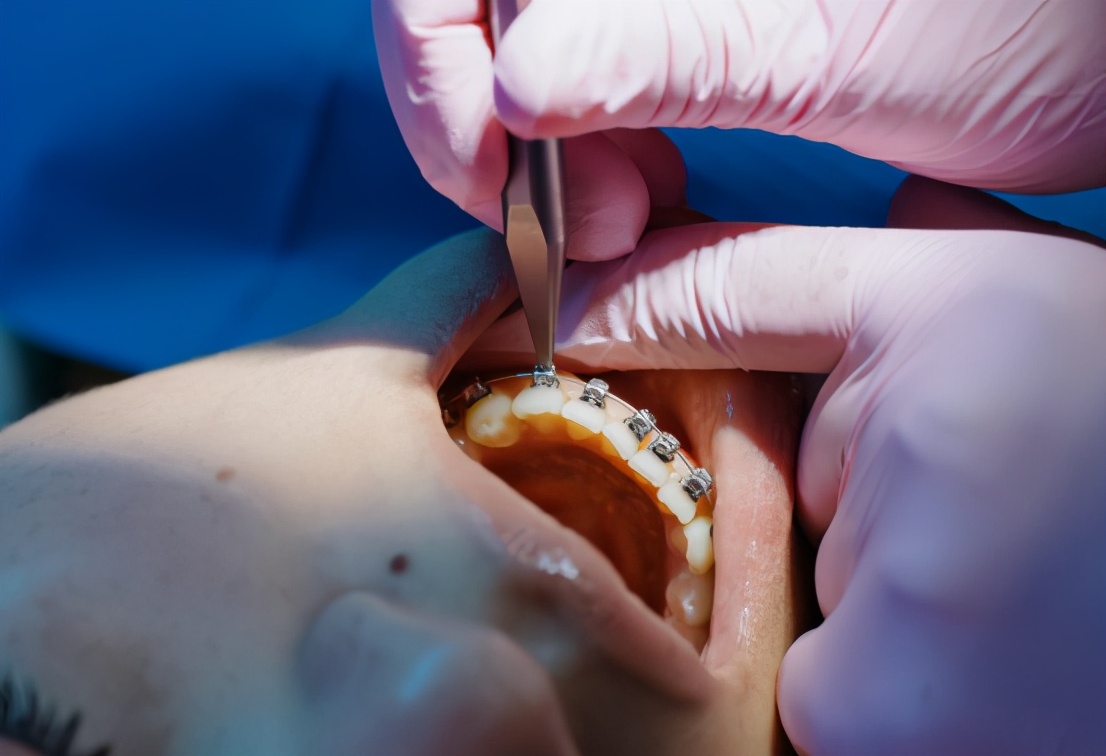 10岁小孩戴隐形牙套好还是钢牙好,青少年正畸选钢牙套还是隐形牙套