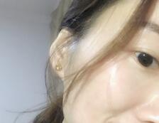 天生脸部泛红怎么改善红血丝特多,血丝斑点如何祛除