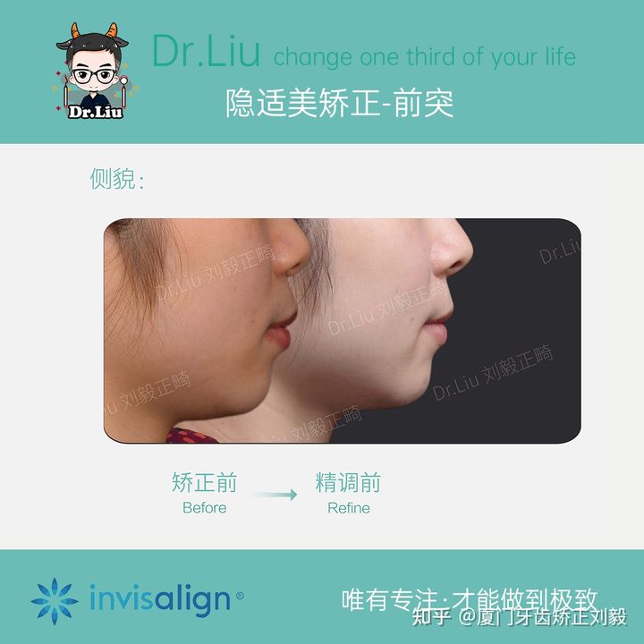 正畸临床拔牙矫治,拔牙正畸矫正嘴凸案例