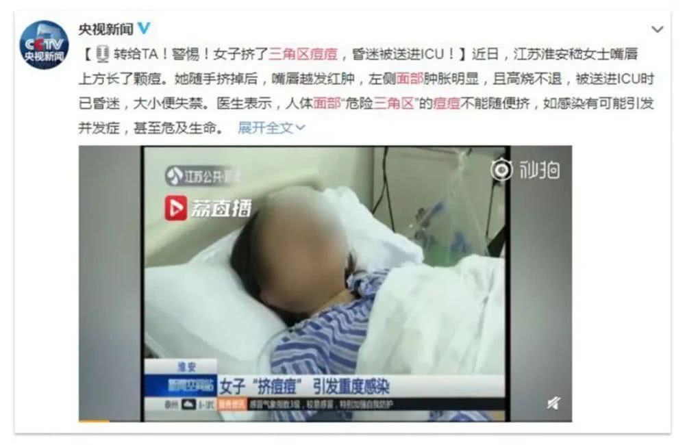 痘痘可以挤吗正确处理方法告诉你,哪种痘痘能挤哪种痘痘不能挤