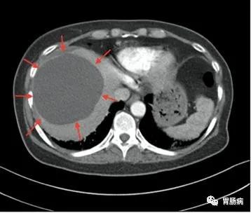 体检查出肝囊肿怎么办医生来教你,体检有肝囊肿怎么办