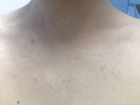 为什么胸前长的痘痘都变成疤痕痘,为什么胸前长很多痘