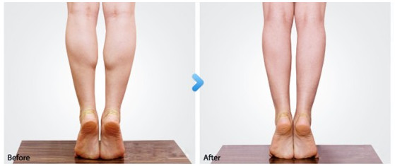 瘦腿针和抽脂哪个瘦小腿明显点,有效瘦腿方法小腿