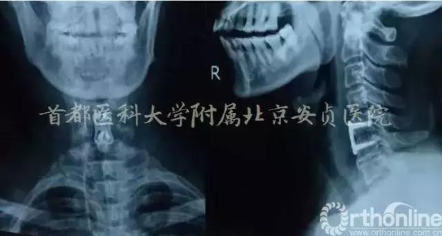 颈椎病引起的胸闷胸痛在哪个部位,颈椎病会引起咳嗽胸闷胸痛吗