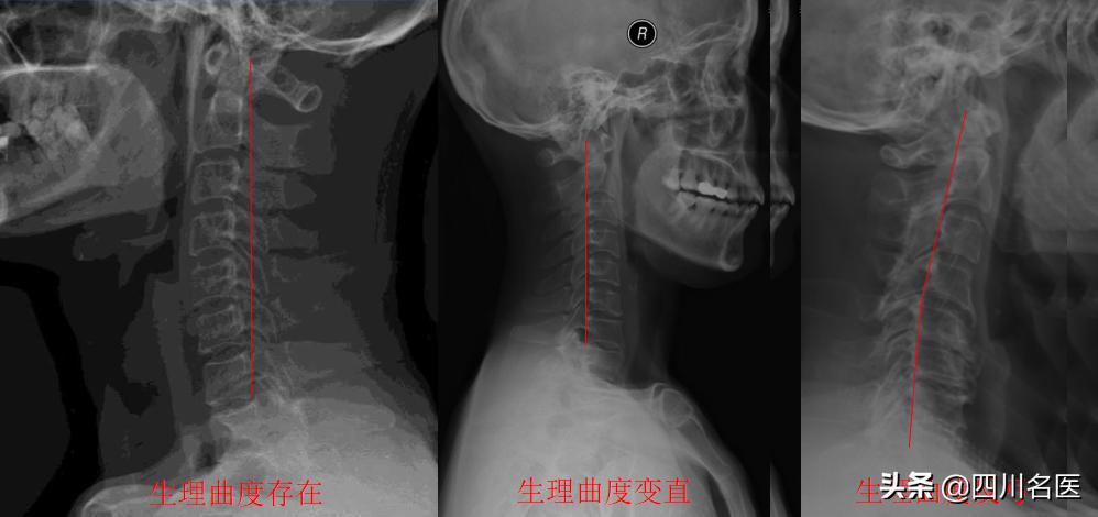 右侧头痛警惕四种病征兆,经常头痛恶心要警惕四种病