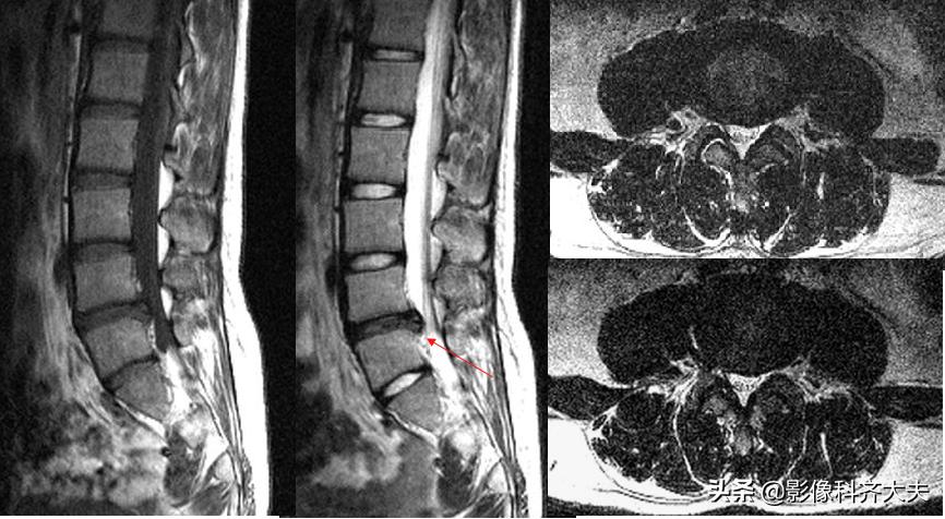 腰椎间盘突出最好的影像诊断方法,腰椎间盘突出的影像学检查