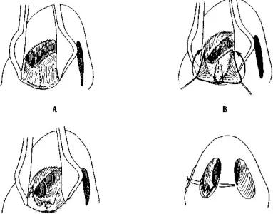 鼻道狭窄引起呼吸困难,先天性鼻道狭窄