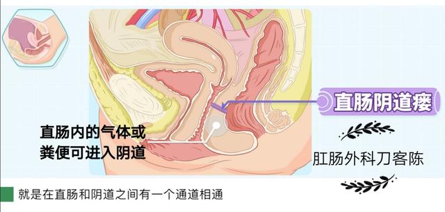 阴道直肠瘘有哪些症状,直肠阴道瘘有哪些症状