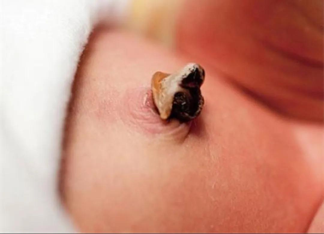 新生儿常见若干问题及解决办法|实用篇