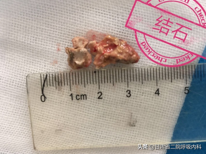 喉咙里面真的有石头吗,喉咙里会长石头吗