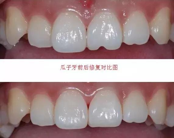 瓜子吃多了会牙齿痛吗,长期吃瓜子对牙齿有影响吗