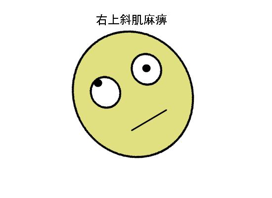 正常眼位和斜视眼位,斜视眼的几大症状