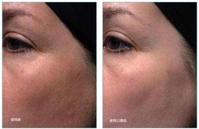 夏天晒黑怎么恢复美白,夏天晒黑了怎么快速变白