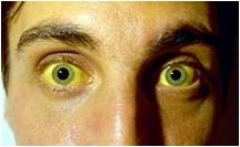 胆结石会引起黄疸腹疼吗,胆结石胆囊炎伴有黄疸应该怎么办