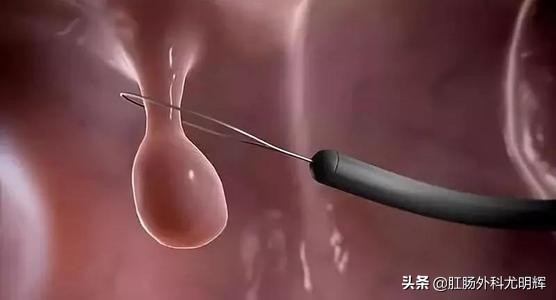 肠道息肉切除肛周坠胀吗,肠道息肉切除流血正常吗