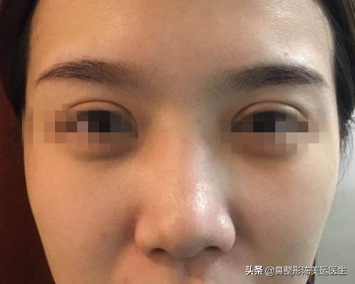 山根混血,混血鼻子山根一般多高