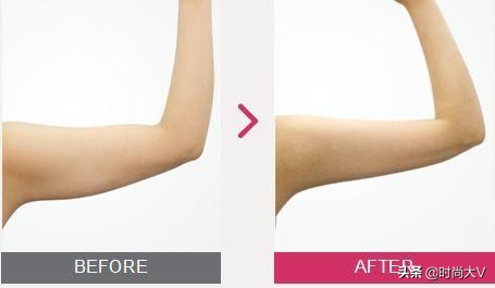 为什么不建议做抽脂,为什么不建议抽脂手术