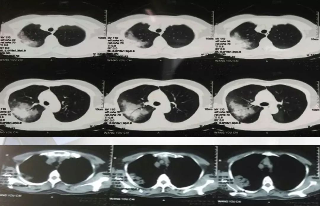 抗感染治疗后效果欠佳，感染非感染？TBLB和肺穿刺病理有哪些提示